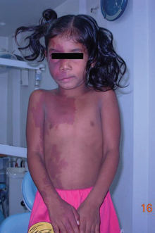 Port wine stains of an 8-year-old female with Sturge-Weber Syndrome Port wine stains of an 8-year-old female with Sturge-Weber Syndrome.png
