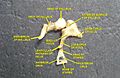 Dissection montrant les 3 osselets de la chaine ossiculaire retirés de la cavité tympanique.
