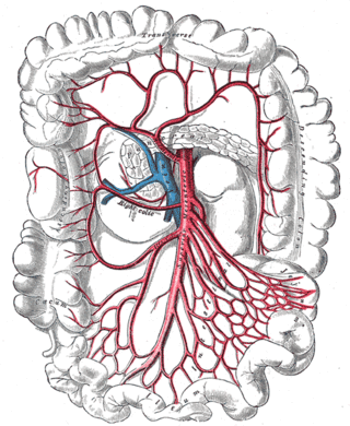 <span class="mw-page-title-main">Isolated superior mesenteric artery dissection</span> Medical condition