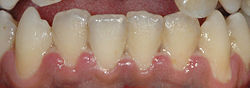 تجلي معتدل نوعًا ما لالتهاب اللثة التقرحي الناخر الحاد في موقع نموذجي على لثة الأسنان الأمامية السفلية.