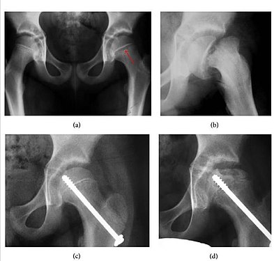 Figure 4: (a) X-ray of a 10-year-old child with left hip pain. It was considered normal at emergency despite the widening of the left physis (arrow). Two weeks later epiphysiolysis was evident (b). Despite appropriate surgical reduction (c) osteonecrosis developed and femoral head collapsed 1 month later (d).[1]