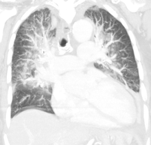 Pulmonary edema on CT-scan (coronal MPR) 18-01-Lungenoedem CT coronar.png