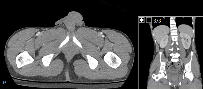 CT of a normal abdomen and pelvis, axial plane 288.png