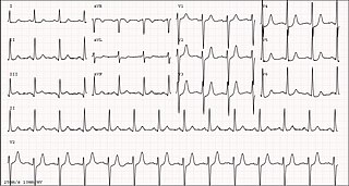 <span class="mw-page-title-main">De Winter syndrome</span> Medical condition