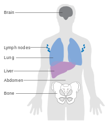 A diagram showing the most common sites for melanoma to spread Diagram showing the most common places for melanoma to spread to CRUK 312.svg
