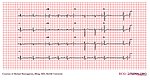 E327 (CardioNetworks ECGpedia).jpg