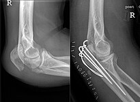 Fracture (left) and repair (right) with three pins, wires, and incision closure with staples Fracture of Olecranon pre and post typical surgery.jpg