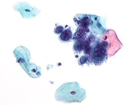 Micrograph showing the viral cytopathic effect of HSV