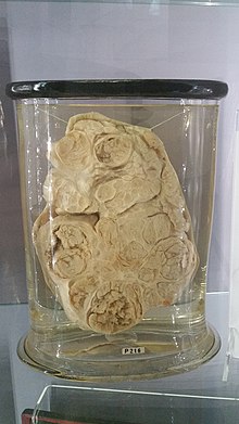 Specimen from a parotid gland tumour. It was removed by John Hunter from a 37-year-old man called John Burley on 24 October 1785. The tumour weighed over 4 kilograms and took twenty-five minutes to remove. The specimen currently resides in the Hunterian Museum at the Royal College of Surgeons of England John Burley's parotid gland tumor - 2.jpg