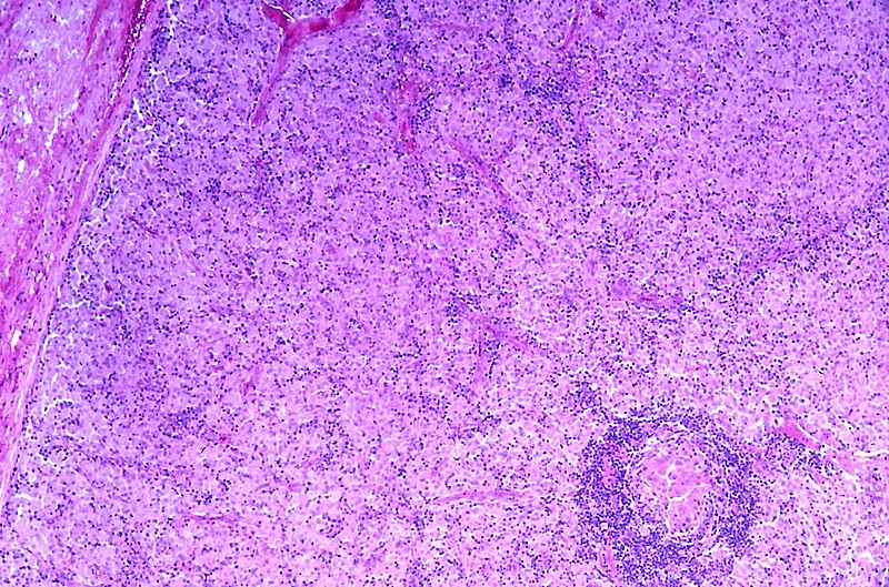 File:Lymph node - Atypical mycobacterial infection (MAI) (7342847924).jpg