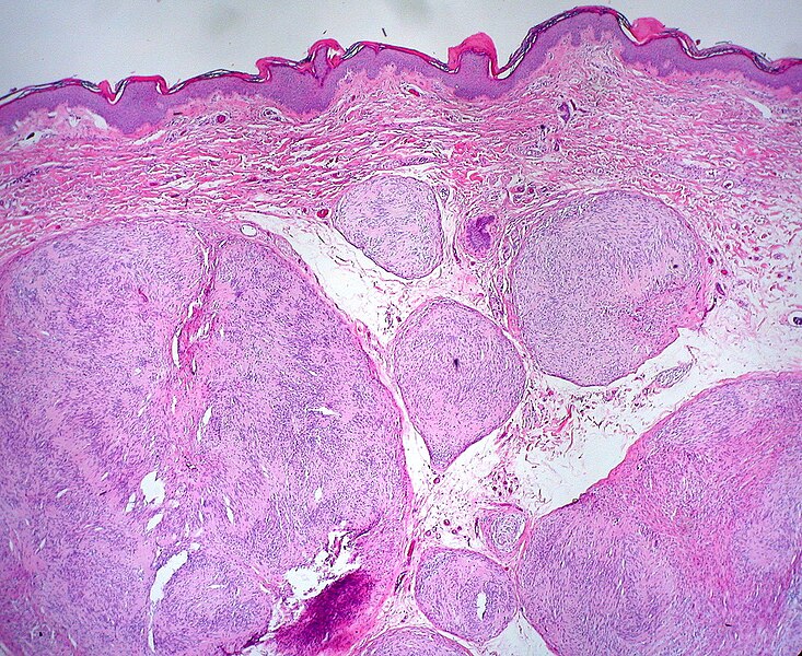 File:Plexiform Schwannoma 1.jpg