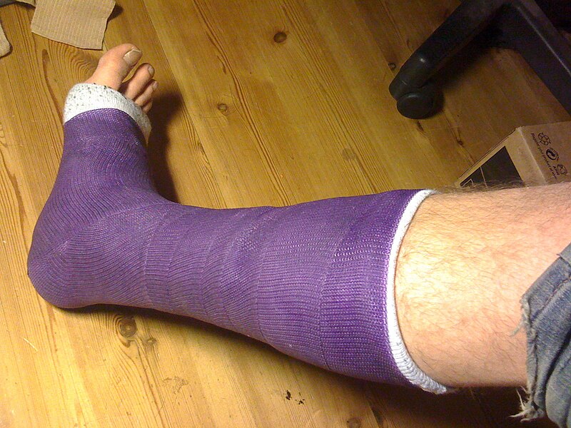 File:Short leg cast.jpg