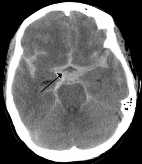 Subarachnoid hemorrhage bleeding into the subarachnoid space