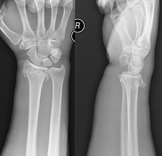 Smiths fracture bone fracture