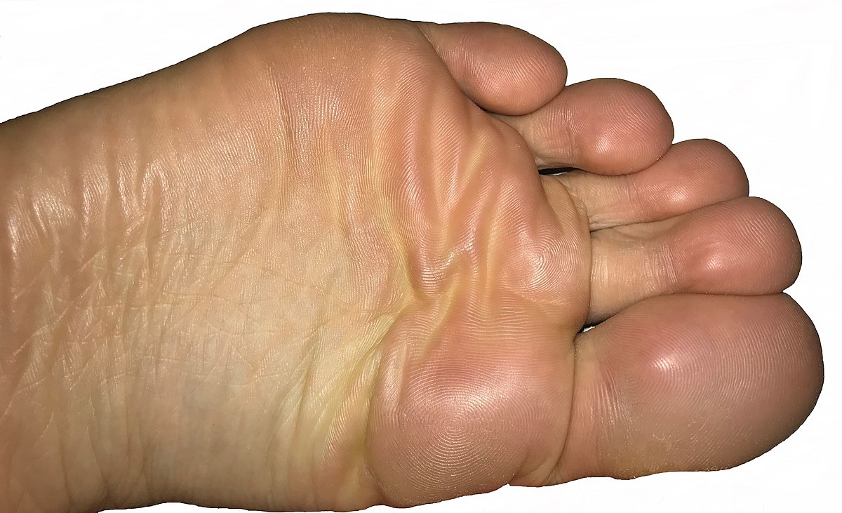 Athlete's foot - Wikipedia