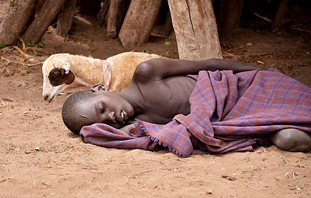 Child with malaria in Ethiopia