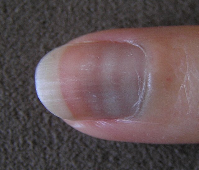 White Spots on Nails (Leukonychia): Causes & Treatment