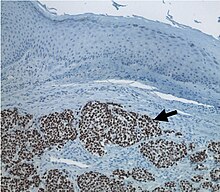Merkel-cell carcinoma (arrow) infiltrating skin tissue, stained brown for Merkel cell polyomavirus large T protein Merkelcellcarcinoma Tag.jpg