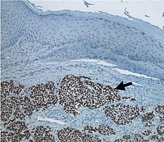 Merkel-cell carcinoma (arrow) infiltrating skin tissue, stained brown for Merkel cell polyomavirus large T protein