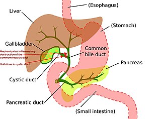 <span class="mw-page-title-main">Mirizzi's syndrome</span> Medical condition