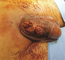 Penile verrucous carcinoma.jpg