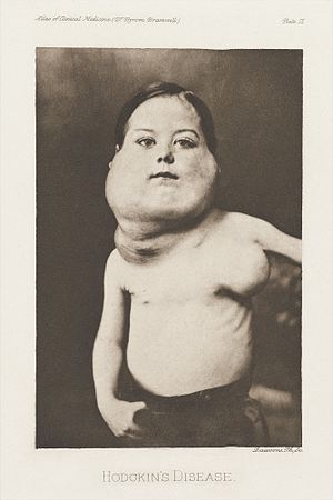 Photographic plate from book, child with Hodgkins disease Wellcome L0040879.jpg