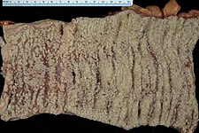 Obraz střevní sliznice s pseudomembranózní enterokolitidou