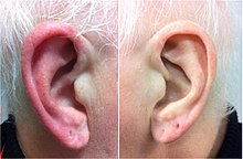 Red ear syndrome 2.jpg