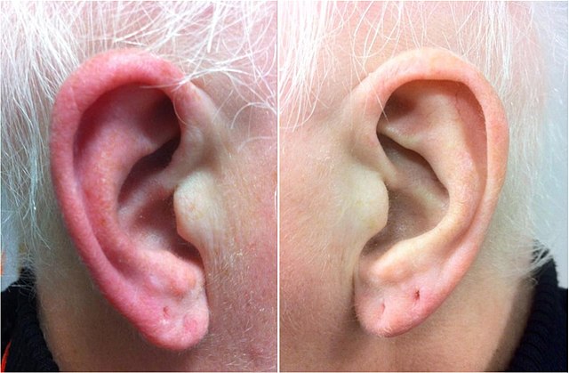 J'ai la sensation d'avoir l'oreille bouchée : que faire ?