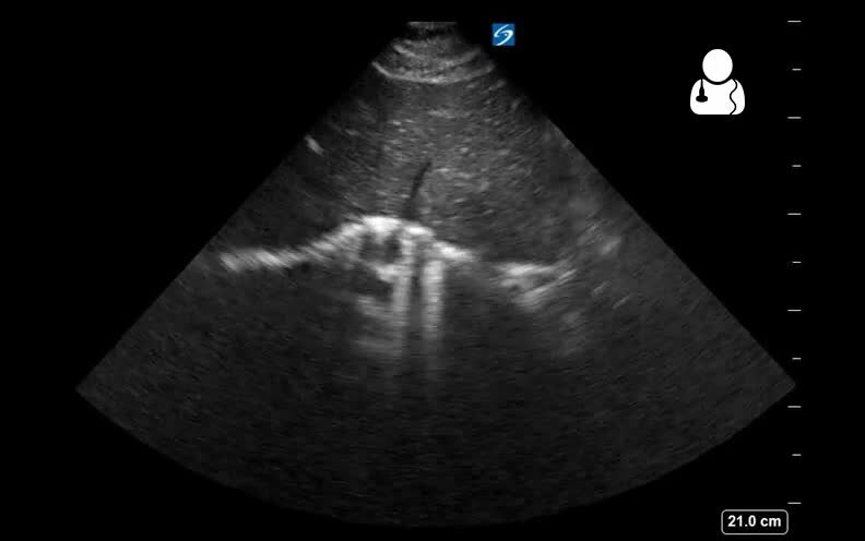 ملف:UOTW 67 - Ultrasound of the Week 1.webm