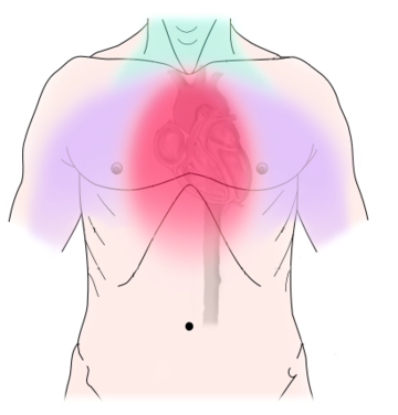 Angina microvascular