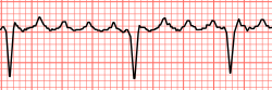 Atrial flutter with varying A-V conduction (3:1 and 4:1)