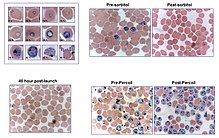 Blood stages of P.falciparum Blood stages of P. falciparum.jpg