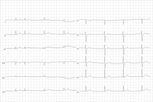 Electrocardiogram from a man with tachycardia-bradycardia syndrome following mitral valvuloplasty, resection of the left atrial appendage, and maze procedure. The ECG shows AV-junctional rhythm resulting in bradycardia at around 46 beats per minute. Brady-tachy syndrome AV-junctional rhythm.png