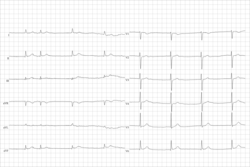 Electrocardiogram from a man with tachycardia-bradycardia syndrome following mitral valvuloplasty, resection of the left atrial appendage, and maze procedure. The ECG shows AV-junctional rhythm resulting in bradycardia at around 46 beats per minute.