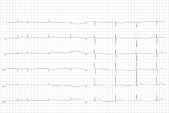 Electrocardiogram from a man with tachycardia-bradycardia syndrome following mitral valvuloplasty, resection of the left atrial appendage, and maze procedure. The ECG shows AV-junctional rhythm resulting in bradycardia at around 46 beats per minute. Brady-tachy syndrome AV-junctional rhythm.png