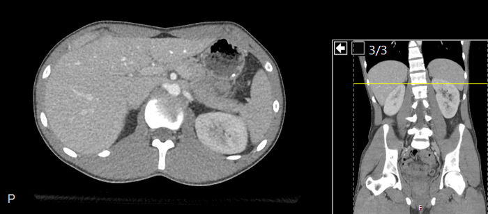 CT of a normal abdomen and pelvis, axial plane 80.png