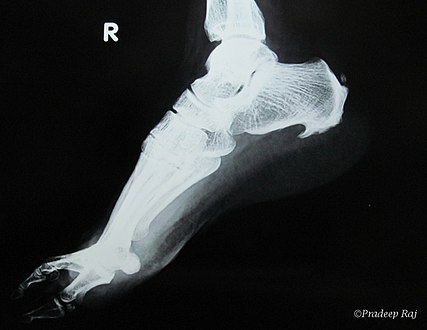 Inferior calcaneal spur