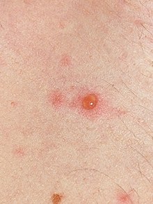Pox symptoms chicken Chickenpox Symptoms