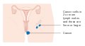 Diagram 1 of 2 showing stage 3B vulval cancer CRUK 498.svg