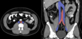 Doppelte Vena cava inferior27jm - CT axial und coronar - 001 - colored.png