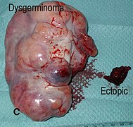 Dysgerminoma and ectopic pregnancy.jpg