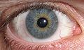 File:Eye Central Heterochromia crop and lighter.jpg