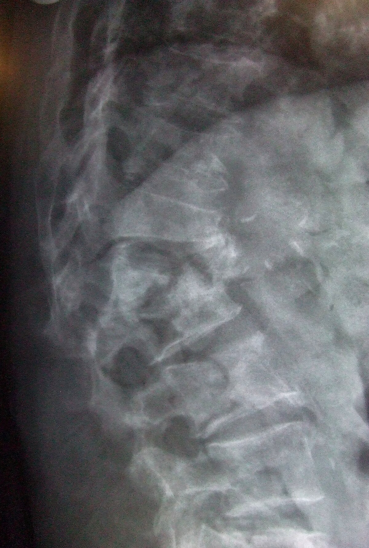 Lateral lumbar spine radiograph with anterior wedge compression