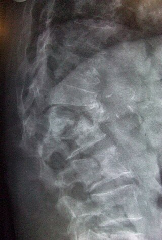 L1 2 vertebral fracture.jpg