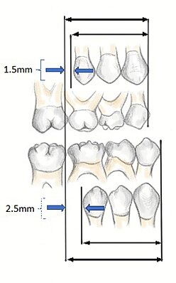 Leeway space is the size differential between the primary posterior teeth (C,D,E) and the permanent teeth (canine, first and second pre-molar). Maxillary space of 1.5mm, mandibular 2.5mm can be seen. (Institute of Dentistry, Aberdeen University) Leeway space.jpg