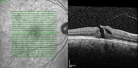 ไฟล์:Macular hole on the right eye.jpg