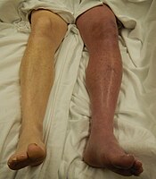 A case of phlegmasia cerulea dolens in the left leg