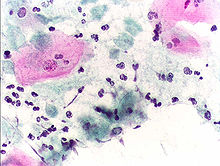 Pap smear, showing infection by Trichomonas vaginalis. Papanicolaou stain, 400x Pap test trichomonas.JPG