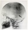 von Elisabeth Fleischman angefertigtes Röntgenbild des Schädels von John Gretzer Jr.